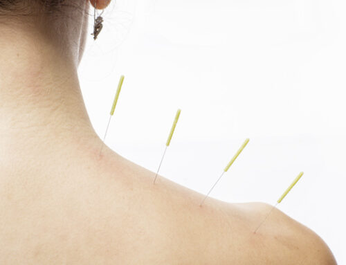 Top Benefits of Acupuncture in North Fitzroy ✨